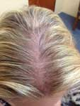 Androgenetic Alopecia after