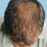 hair transplant surgery after