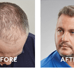 Hair Loss & Growth Treatment South Africa - Advanced Hair Studio Hair Loss & Growth Treatment South Africa - Advanced Hair Studio