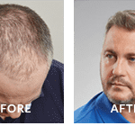 Darren Gough Before After Hair Loss