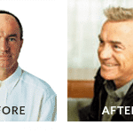 Greg Matthews Hair Loss Before After