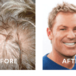 Shane Warne Before and After Hair Loss