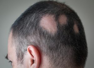 Alopecia-Male