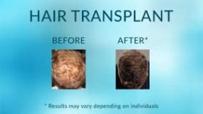 Hair Transplant Before and After