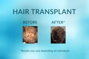 Hair Transplant Results - Before & Afters / Success Rate
