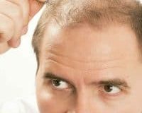 How To Stop Hair Loss