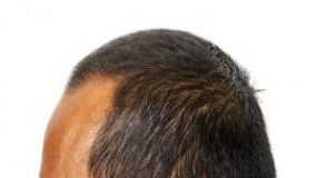 How to Get Rid of A Widows Peak