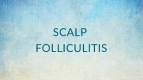 Scalp Folliculitis