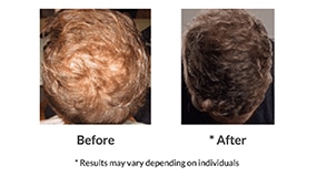 Stem Cell Hair Therapy Before After Photo