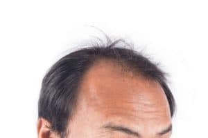 male pattern baldness