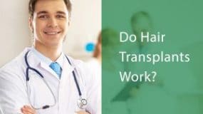 Do Hair Transplants Work