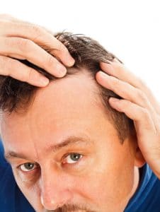 Hair Loss Symtoms Causes Signs Problems Of Pattern Baldness