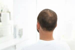 Best Haircut for a Receding Hairline - Options For Thinning / Baldness