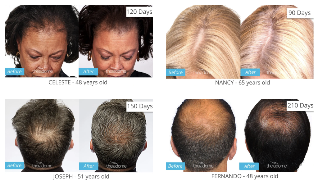 Theradome Laser Hair Growth Helmet Advanced Hair Studio