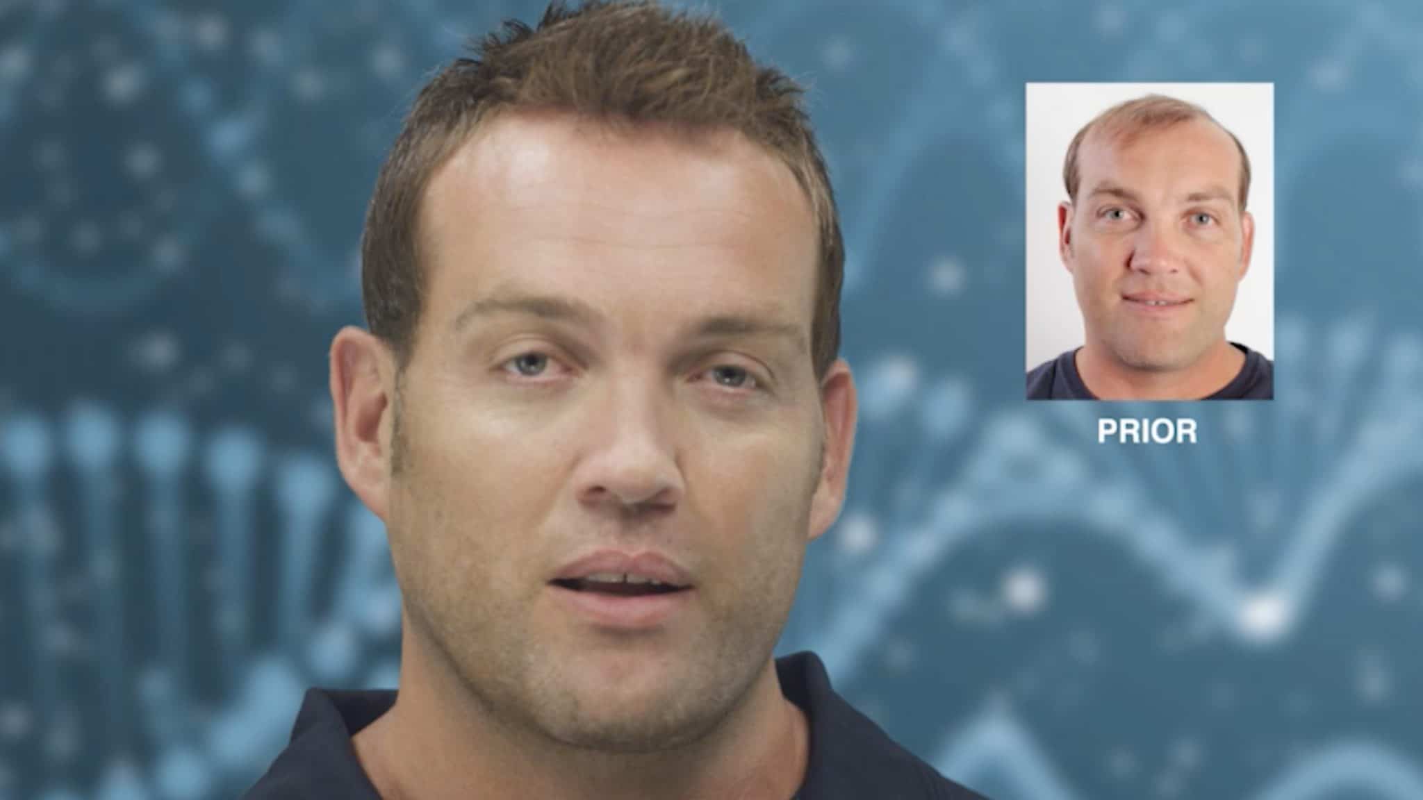 Hair Loss Growth Treatment South Africa Advanced Hair Studio