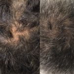 Ahc Prp 4 Treatments 6 Months Jpg