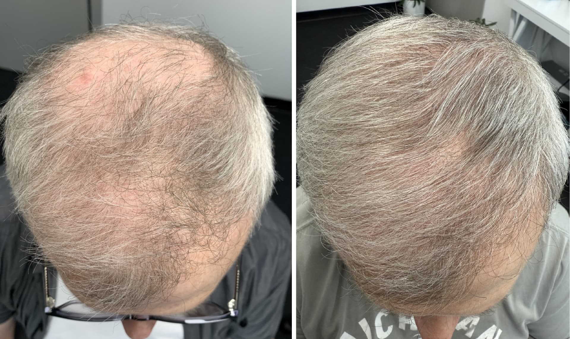 Advanced Hair Strand By Strand Before And After Jpg