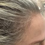After Woman Hairline Jpg