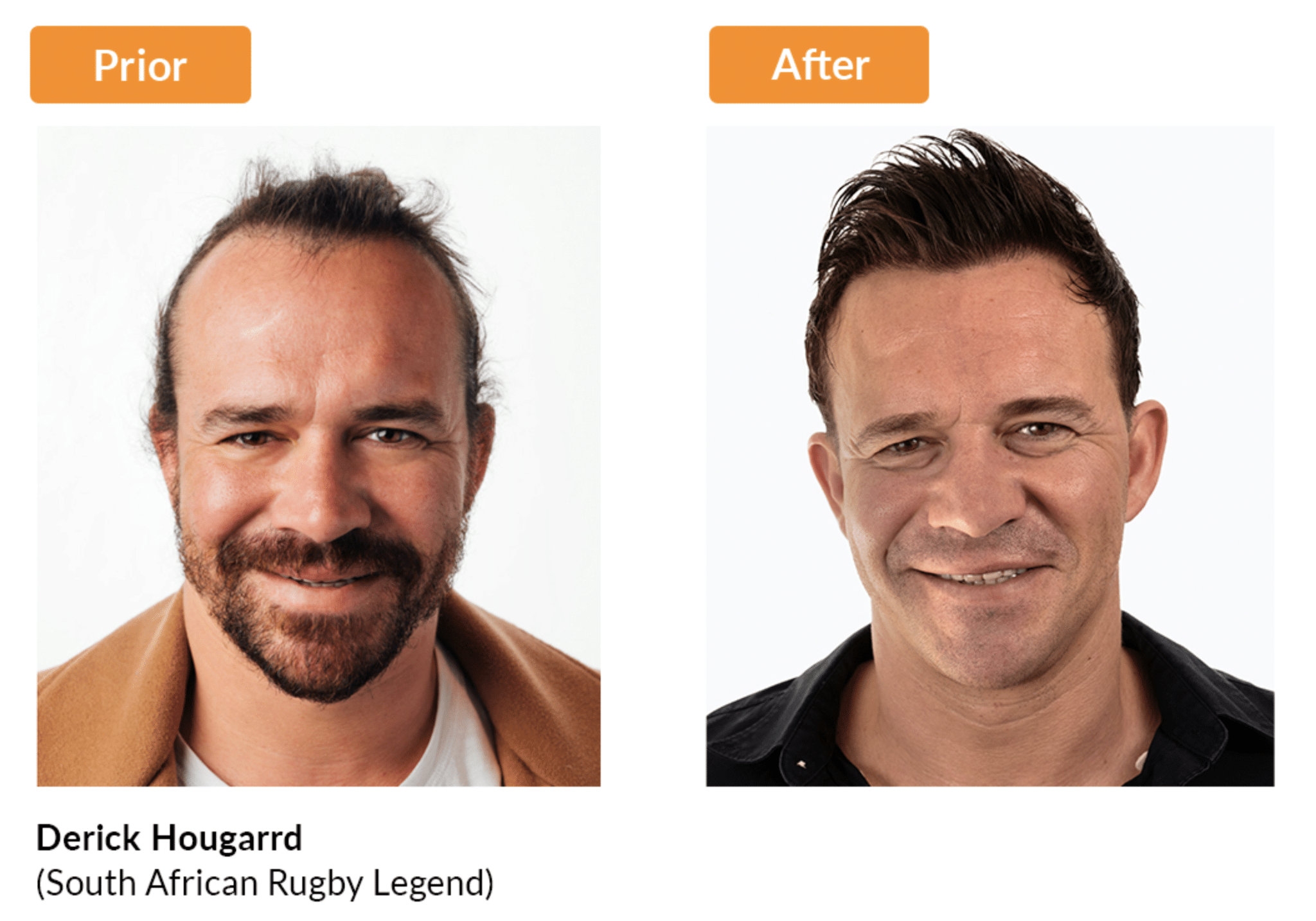 Before After Strand By Strand Hair Transplant Png