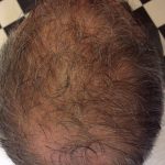 Prp 2 Before Jpg