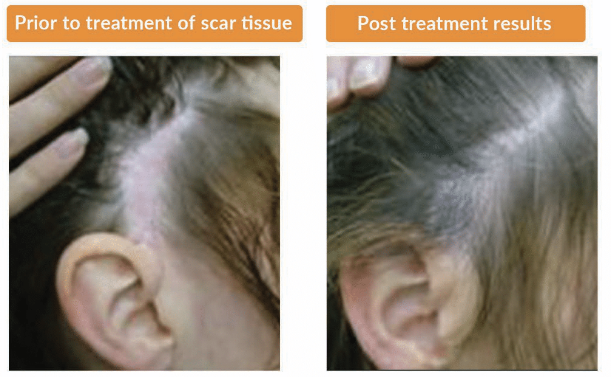 Scar Treatment Png
